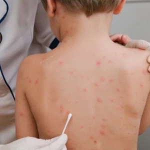 Angka Suspek Campak di Kabupaten Gorontalo Capai 102 Kasus