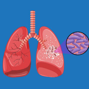 TBC di Kabupaten Gorontalo Capai 1.020 Kasus, Pemda Perlu Penanganan Kolaboratif